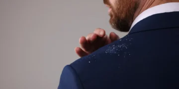 Já tentou de tudo e a caspa não desaparece? Aqui estão 5 métodos naturais