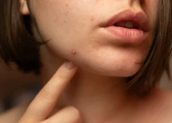 Sabia que o acne hormonal pode aparecer em qualquer idade?