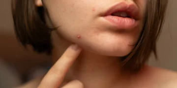 Sabia que o acne hormonal pode aparecer em qualquer idade?