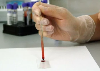 Leucemia? Teste de sangue poderá substituir amostras de medula na deteção