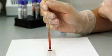 Leucemia? Teste de sangue poderá substituir amostras de medula na deteção