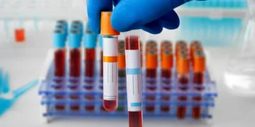 Cancro do estômago: Tipo de sangue pode ser fator de risco