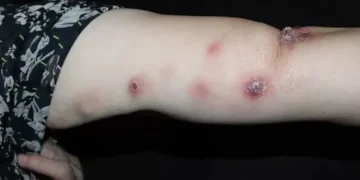 Santa Catarina promove capacitação inédita sobre esporotricose para profissionais de saúde e meio ambiente