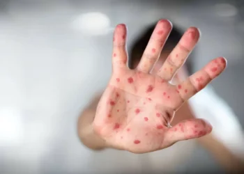 UE com mais de sete mil casos de sarampo. Em Portugal, foram 21, com DGS a salientar “cobertura vacinal elevada”