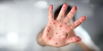 UE com mais de sete mil casos de sarampo. Em Portugal, foram 21, com DGS a salientar “cobertura vacinal elevada”